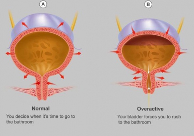 8 Ways to Tame Bladder Control Problems