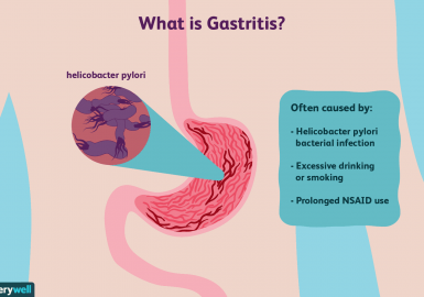 What is Gastritis?