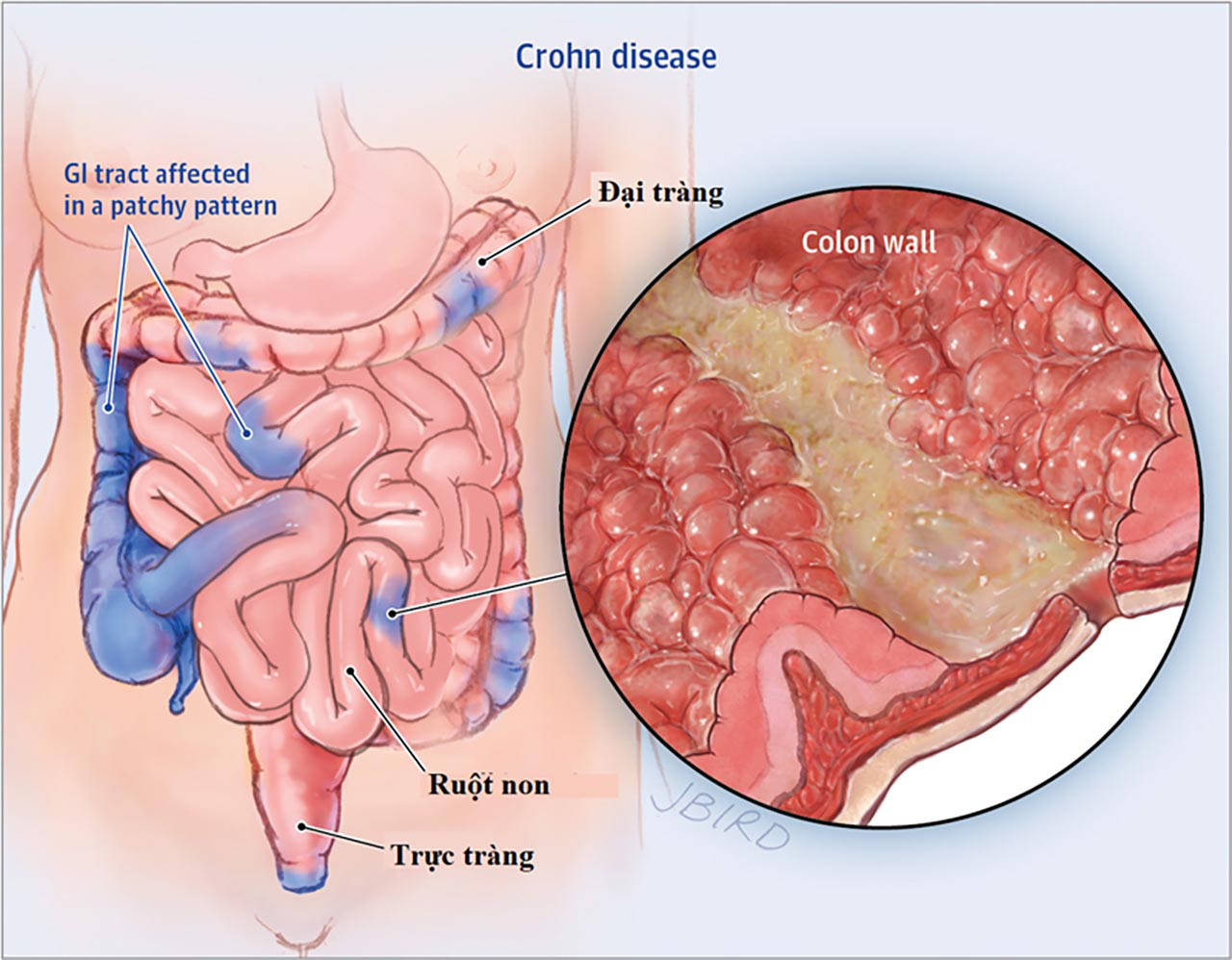 Crohn's Disease là bệnh gì? Nguyên nhân, triệu chứng và cách điều trị hiệu quả